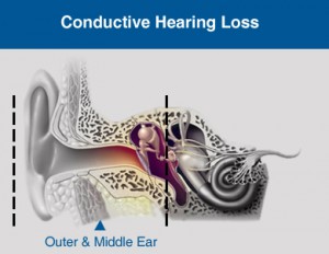 Conductive hearing loss